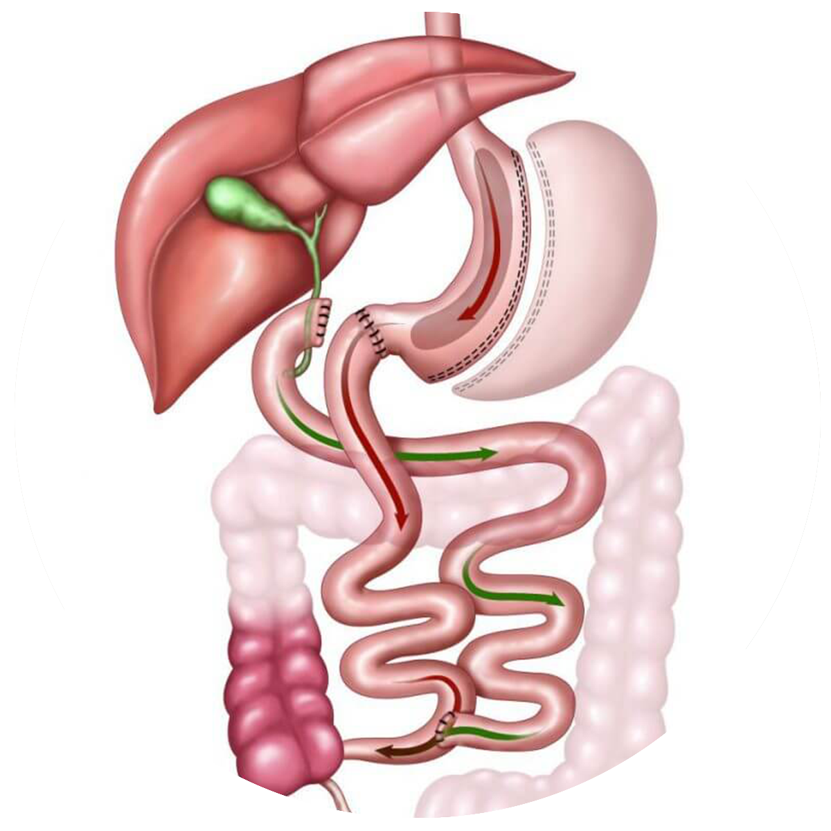 duodenal-switch