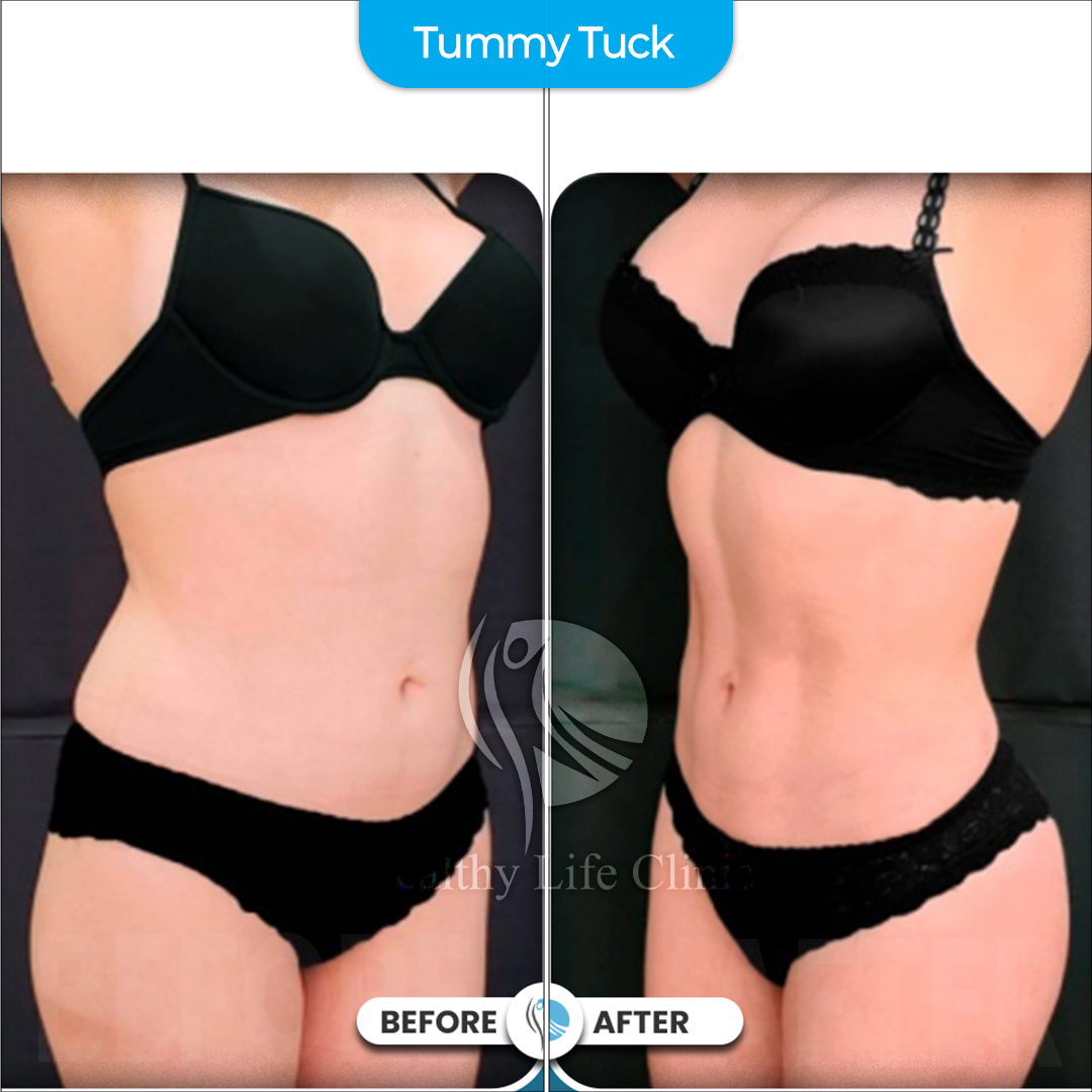 Tummy Tuck