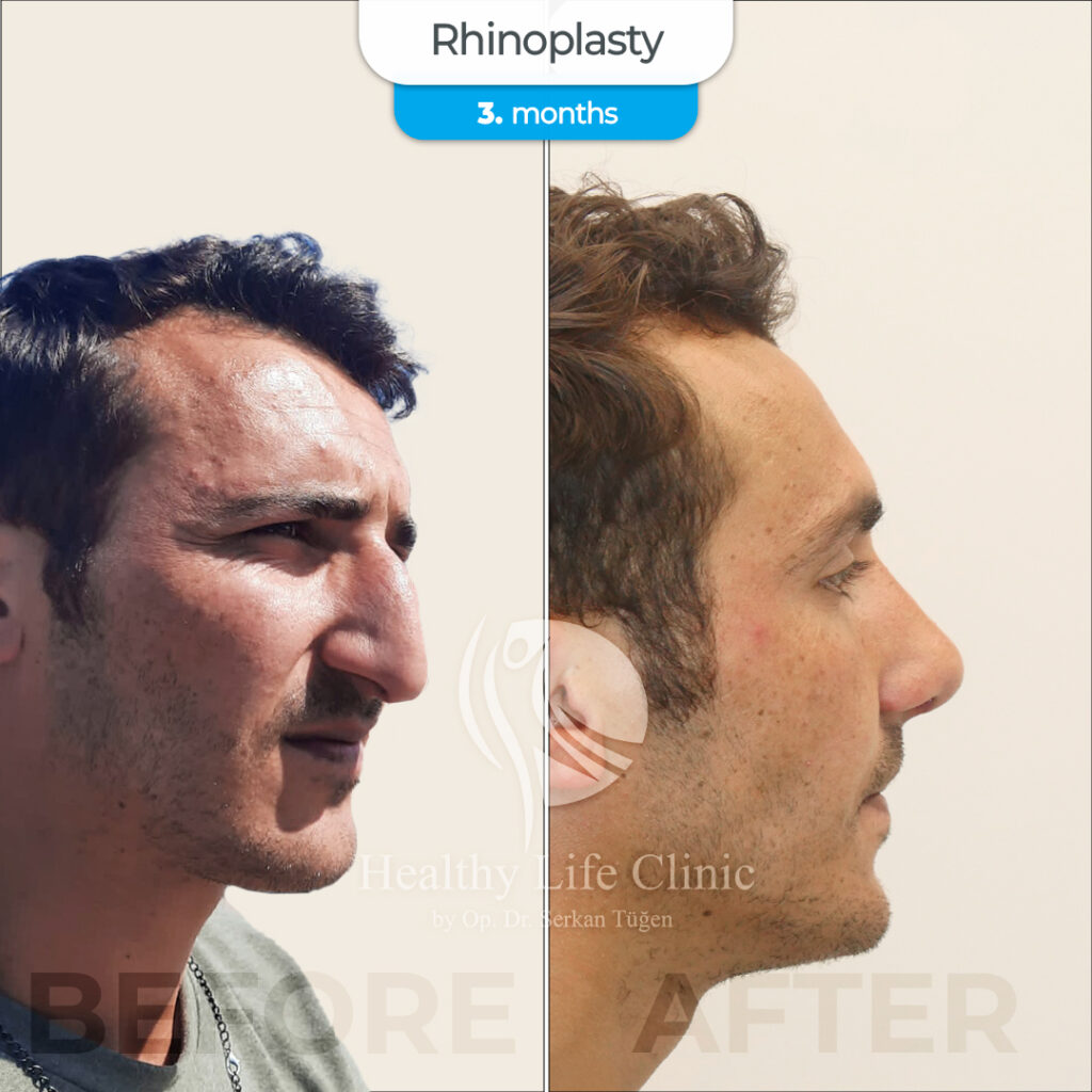 Rhinoplasty