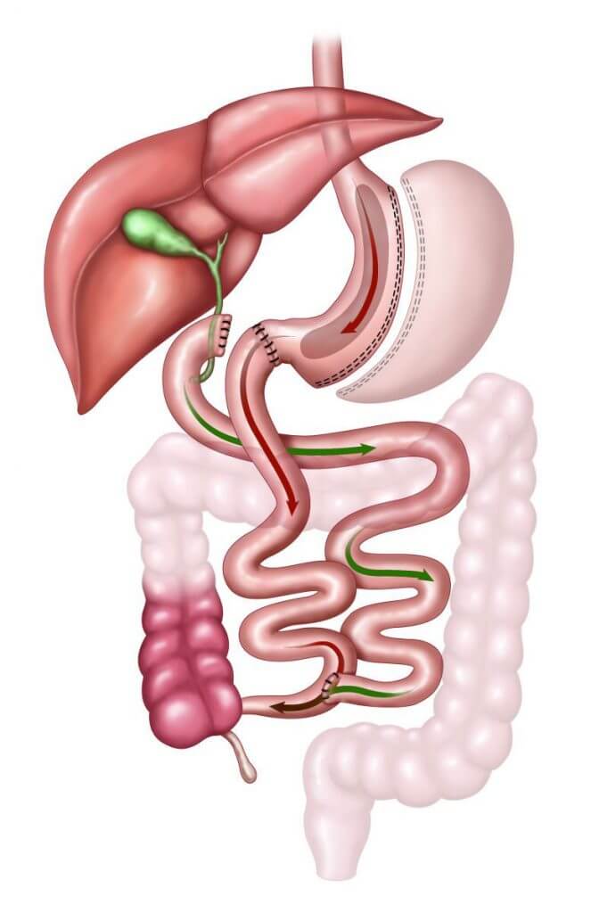 duodenal switch