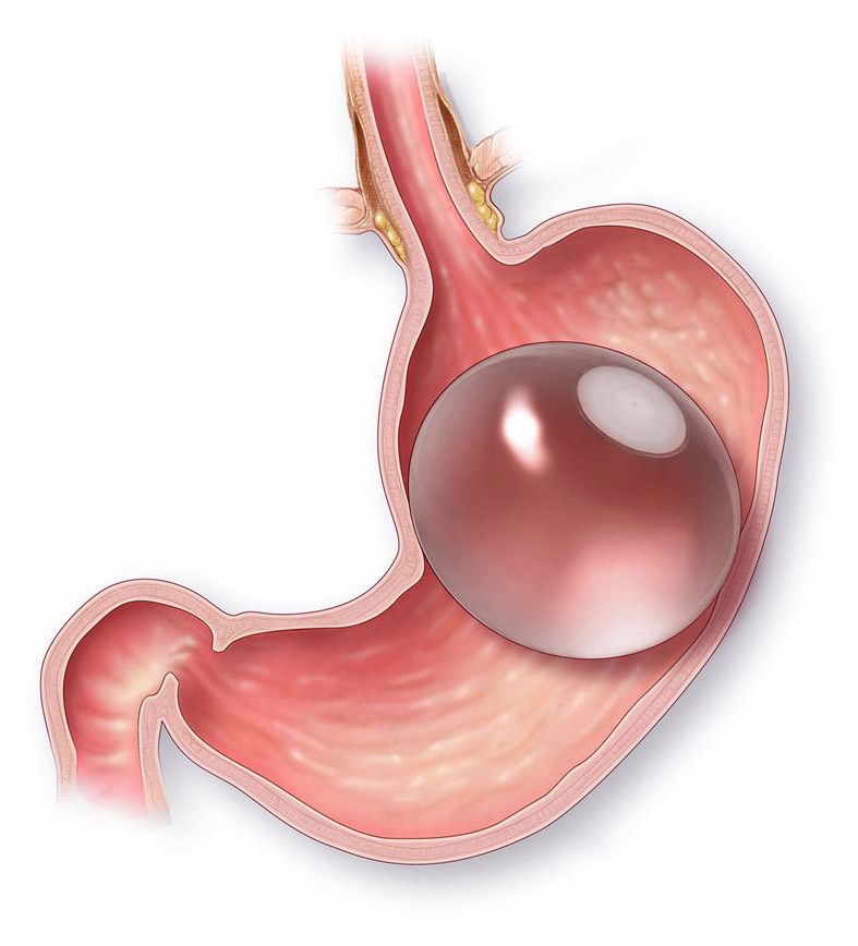 gastric balloon