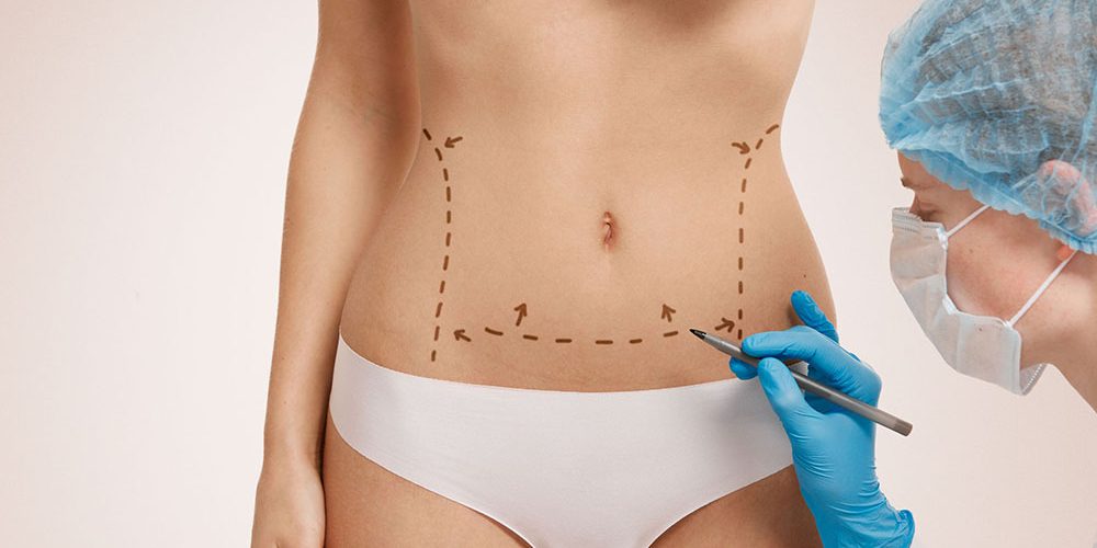 tummy tuck